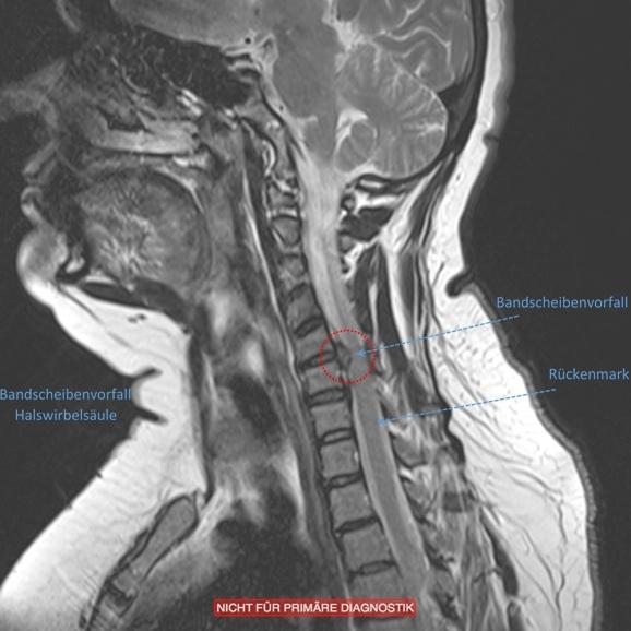 Bandscheibenvorfälle (NPP) Neurochirurgische Wirbelsäulenpraxis Dr. med. M. Farhadi Bandscheibenvorfälle (NPP) Neurochirurgische Wirbelsäulenpraxis Dr. med. M. Farhadi