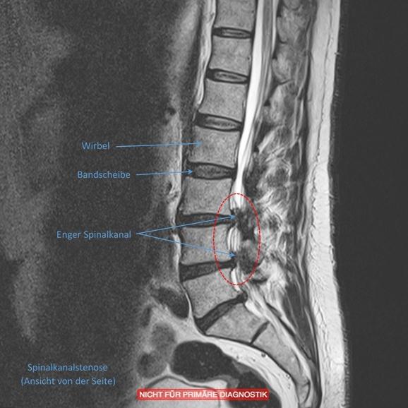 Spinalkanalstenosen (SKS) Neurochirurgische Wirbelsäulenpraxis Dr. med. M. Farhadi